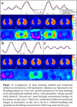 Deep learning based reconstruction enables high-resolution electrical impedance tomography for lung function assessment
